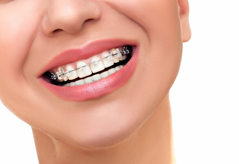 Ortodoncia Dentistas en El Prat de Llobregat y Sitges